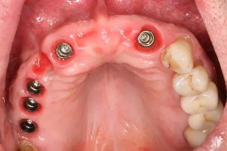 Implantáty v horní čelisti, hojící se řešení